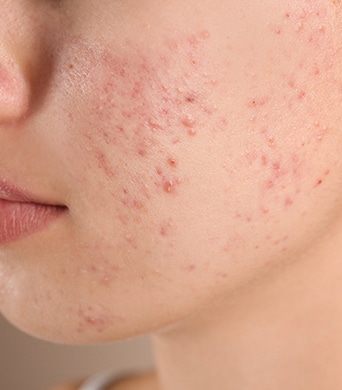 Woman with acne on her face