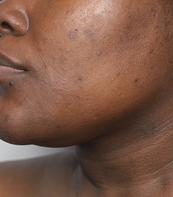 Woman with hyperpigmentation on her face