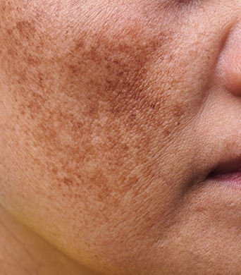 Melasma on woman's face