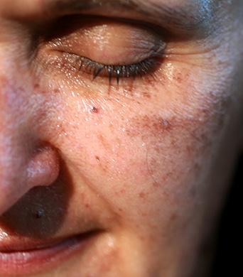 Skin Discoloration on woman's face